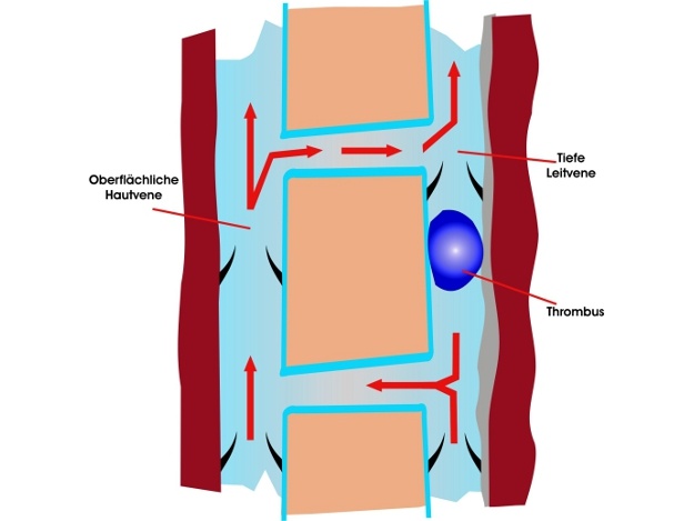 Thrombose